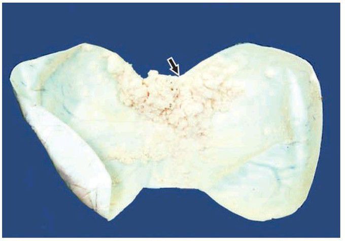 Papillary serous cystadenocarcinoma of the ovary.