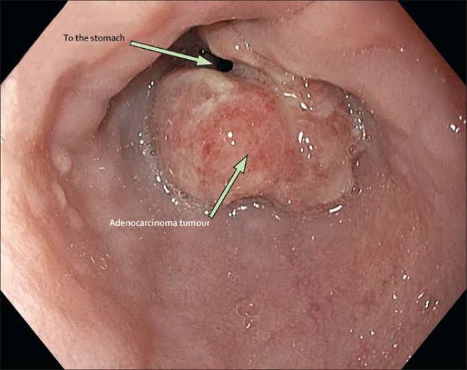 Symptoms of esophageal cancer