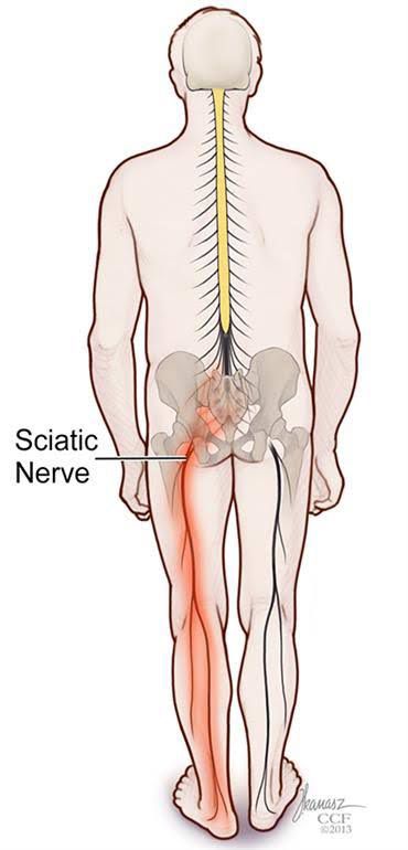 Sciatica - MEDizzy