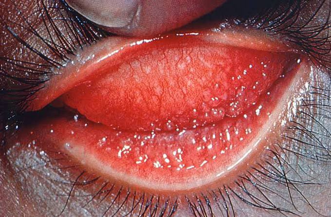 Trachoma