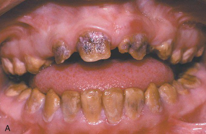 Hypocalcified Amelogenesis Imperfecta. 