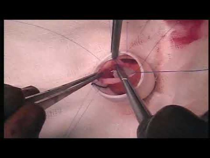 Dacron Graft Encased Modified Ross Operation