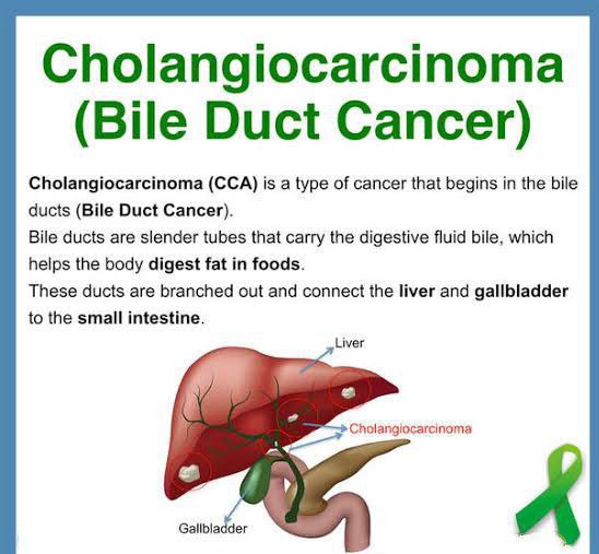 Visual representation of Bile duct cancer - MEDizzy