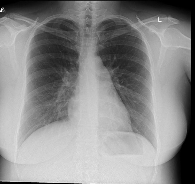 34y/o female chest xray