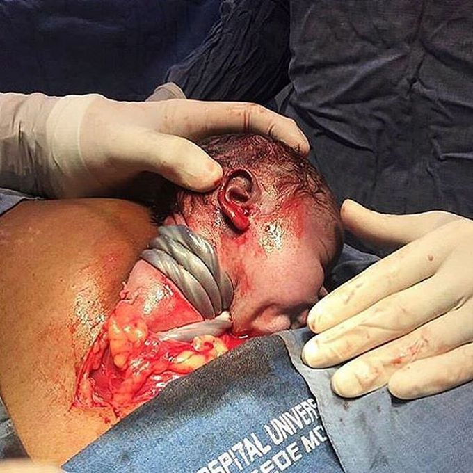 Urgent life-saving cesarean section due to nuchal cord.