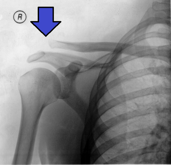 Treatment for Shoulder Separation