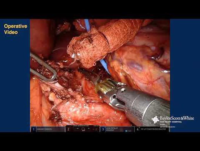 Robotic-Assisted Median Arcuate Ligament