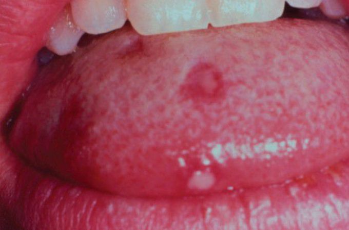 Aphthous ulcer