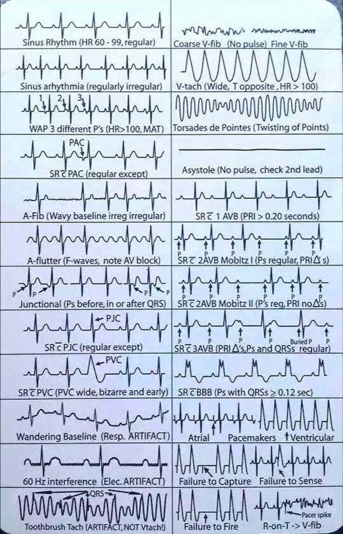 Arrhythmia