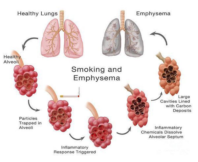 Lungs - MEDizzy