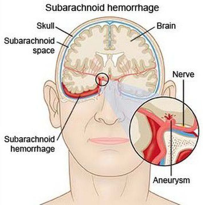 Subarachnoid Hemorrhage :-