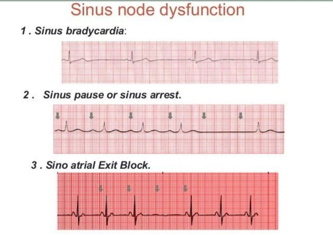 Sinus Node Dysfunction - MEDizzy