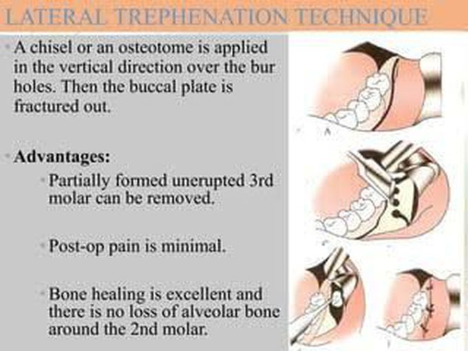 Lateral trephination technique