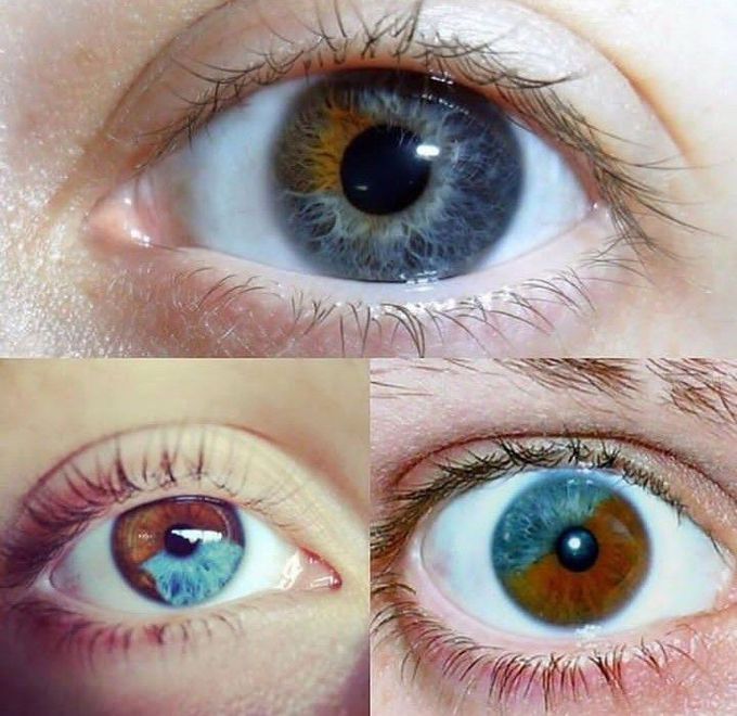 Heterochromia