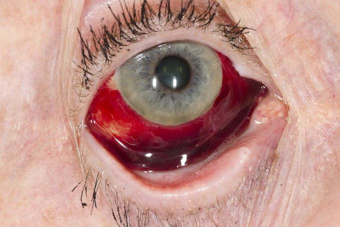 SUBCONJUNCTIVAL HEMORRHAGE