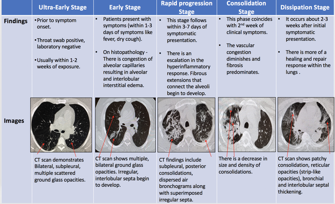 CT Scan Findings in Difference Stages of Coronavirus Infection
