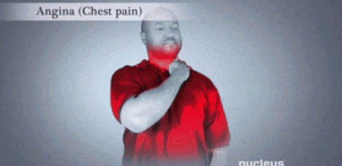Angina