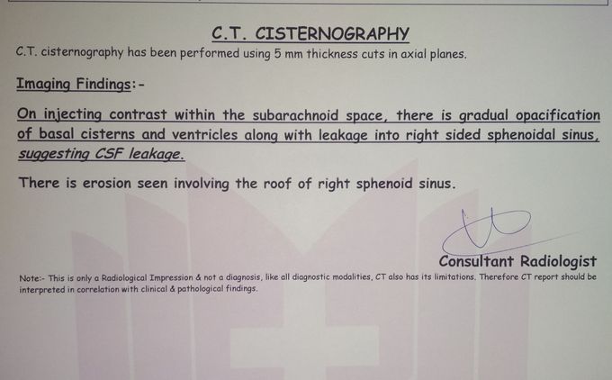 CSF RHINORRHEA