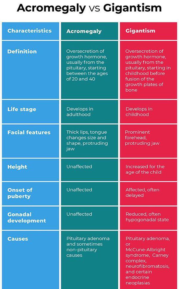 Acromegaly Vs Gigantism