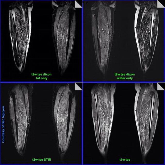 MSK Imaging – Myositis of the calves
