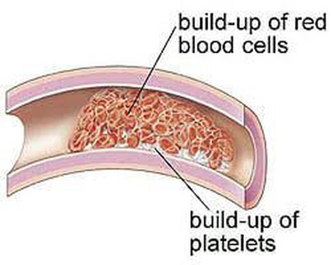 Common types of blood clotting disorder