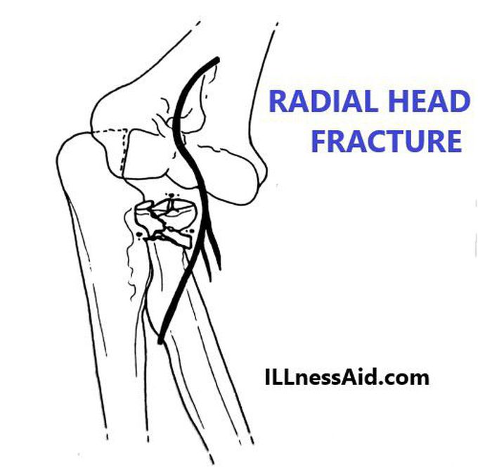 Radial Head Fracture: Classification, Treatment, and More - ILLnessAid