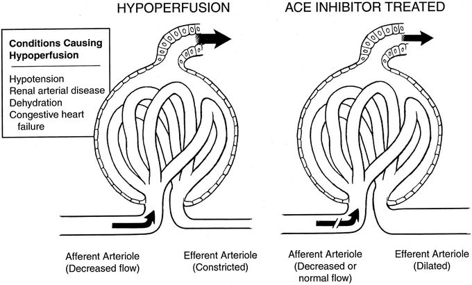 Acute Renal Failure with ACE Inhibitors