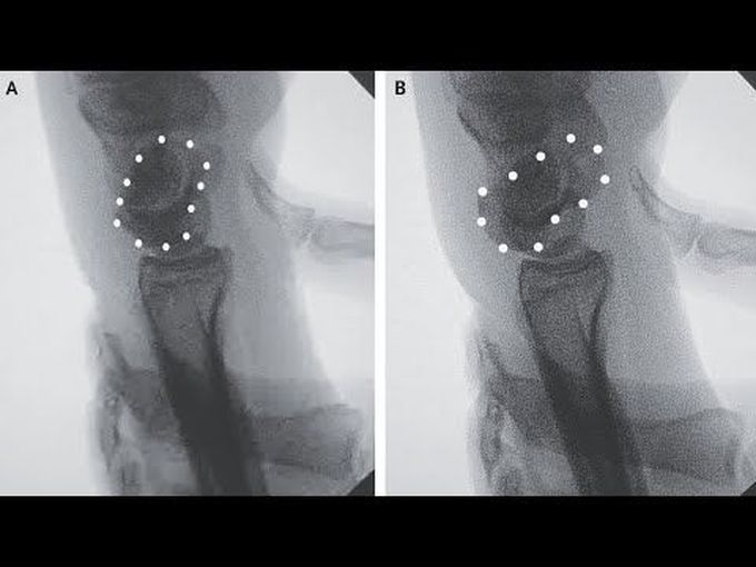 Scaphoid Shift Test in Scapholunate Ligament Injury