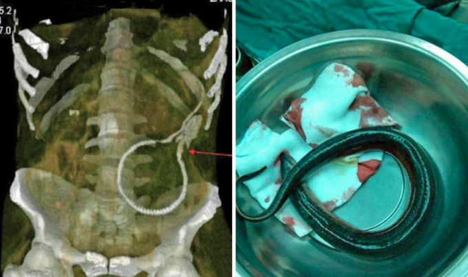 Eel Removed From Man After Getting Stuck, Chewing Through Colon