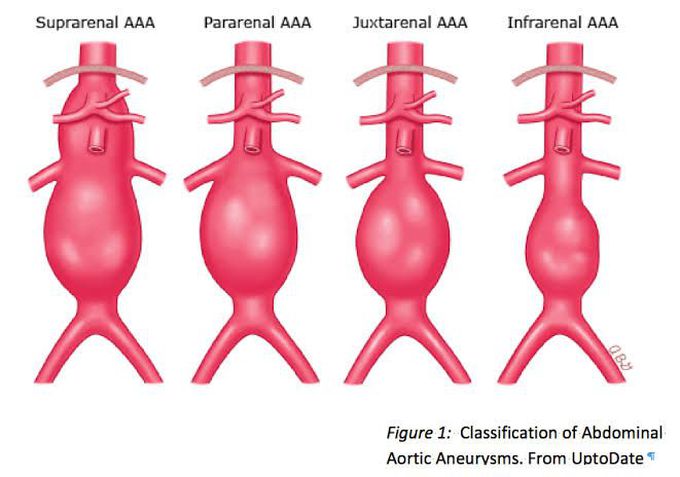 Classification of Abdominal Aortic Aneurysm