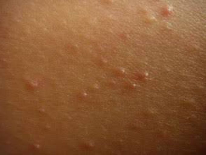 Keratosis Pilaris