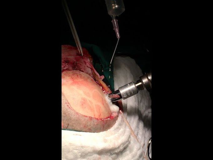 Craniotomy and craniectomy