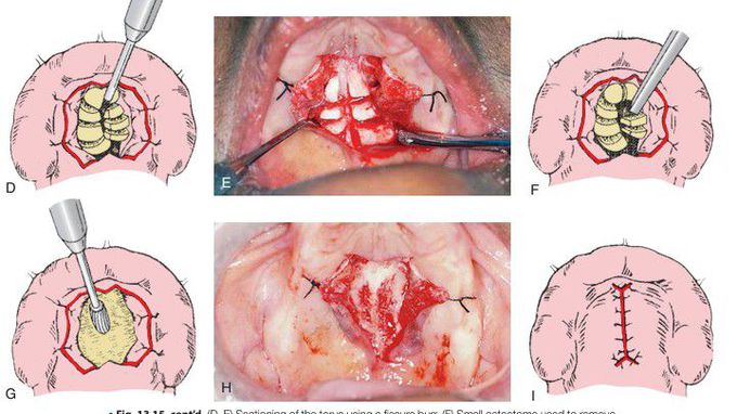 Palatal torus removal