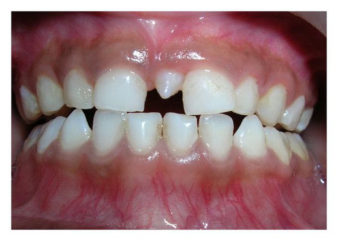 Supernumerary Teeth