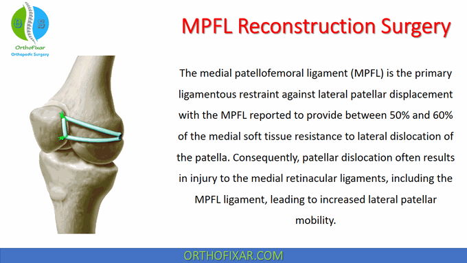 MPFL Reconstruction Surgery â¢ Easy Explained - OrthoFixar 2022