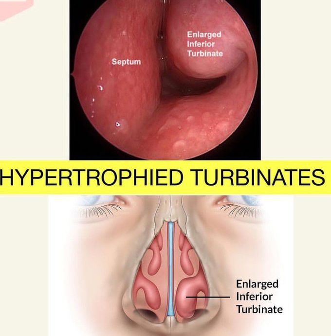 Hypertrophied Turbinates