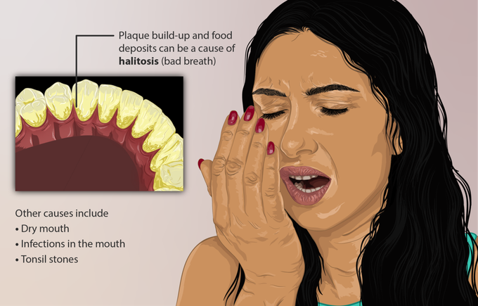 How is halitosis treated?