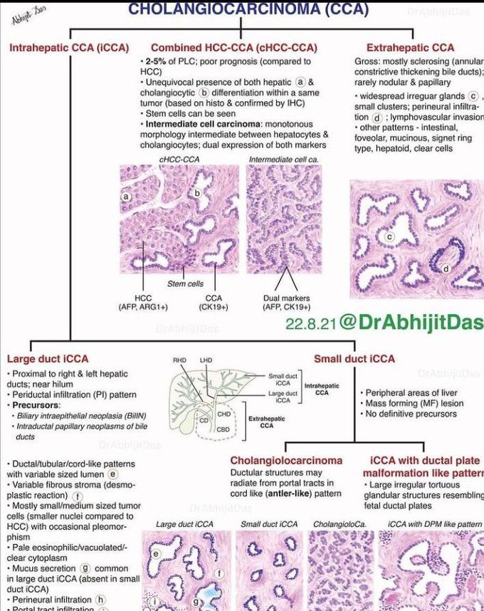 Cholangiocarcinoma