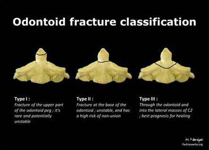 Odontoid Fracture classification