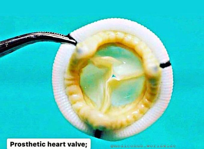 Prosthetic heart valve