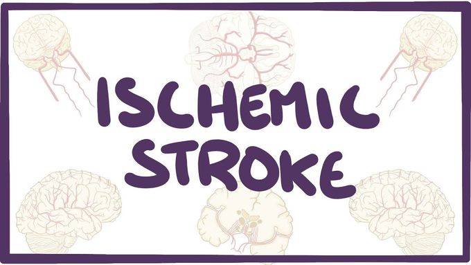 Ischemic Stroke - causes, symptoms, diagnosis, treatment, pathology