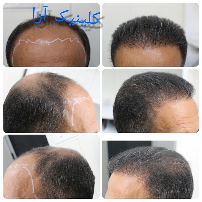 Hair line design