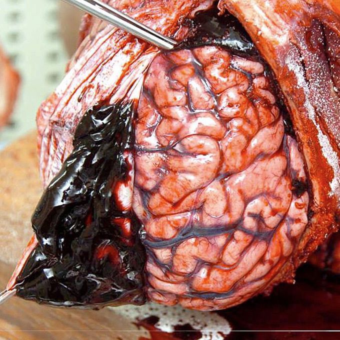 Subdural hematoma!
