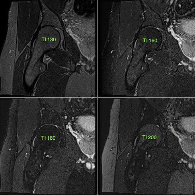 Effects of STIR imaging in the hips