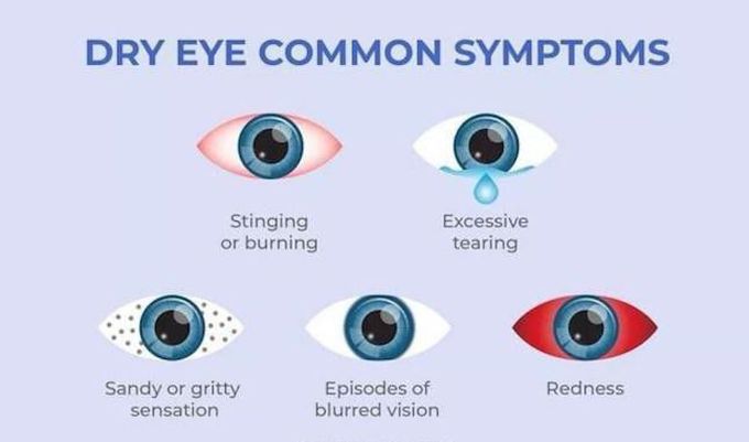 Dry eye syndrome