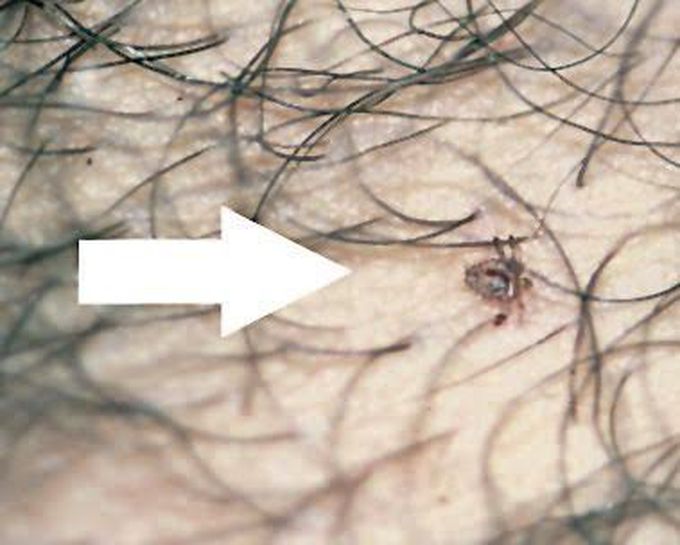 Pediculosis Pubis (Pubic Lice)