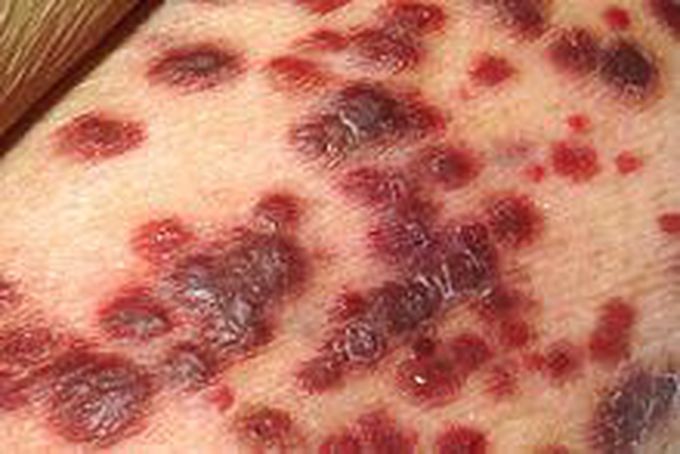Kaposi’s sarcoma