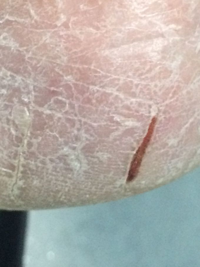 Calcaneal fissure