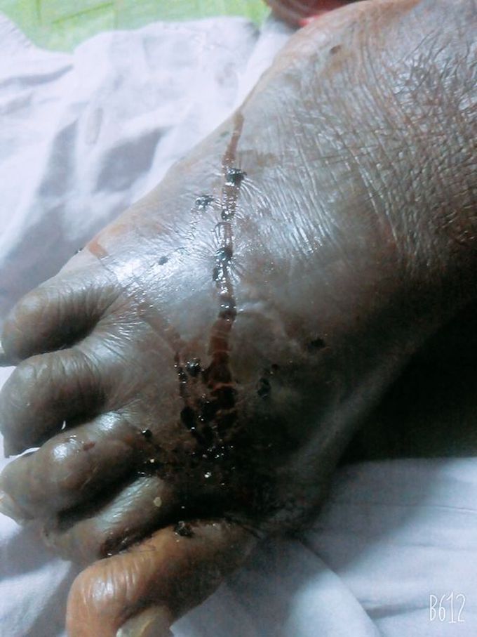 This is dog bite legg