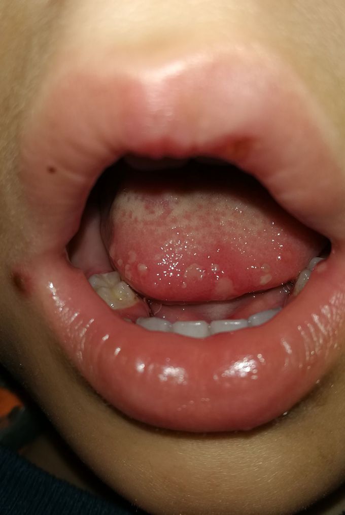 2 yrs baby have white plaque in mouth